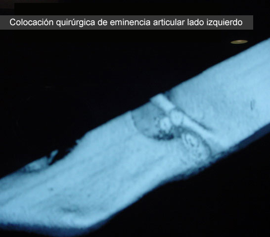 Eminencia articular (caso clínico)