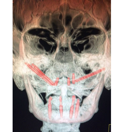 Zygomatic implants (reference)