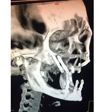Zygomatic implants (illustration)