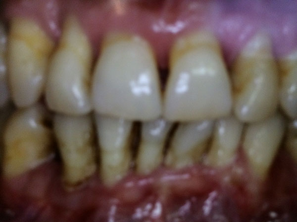 Advantages of zygomatic implants