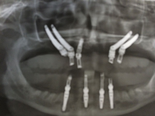Zygomatic implants