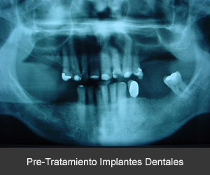 Tratamiento con implantes dentales
