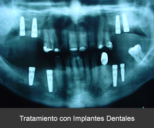 Tratamiento con implantes dentales