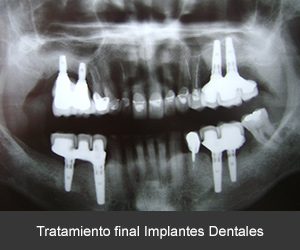 Resultado final de implantes dentales