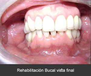 Rehabilitación bucal con implantes dentales