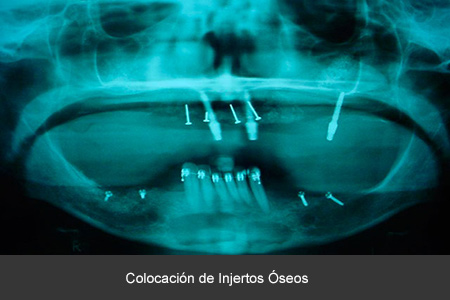 Rehabilitación bucal con implantes dentales