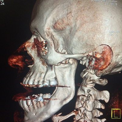 Luxación mandibular bilateral completa