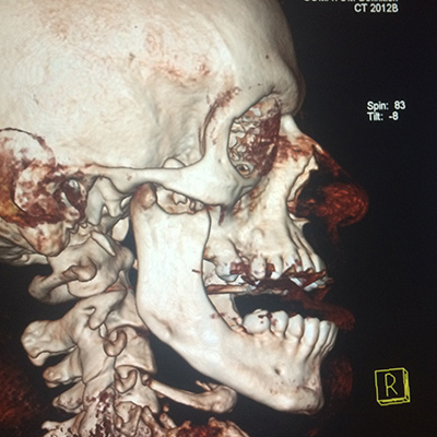 Luxación mandibular bilateral completa