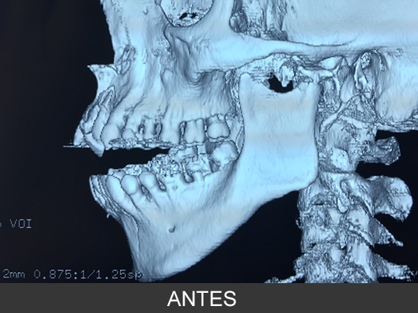 Fractura bilateral de cóndilos