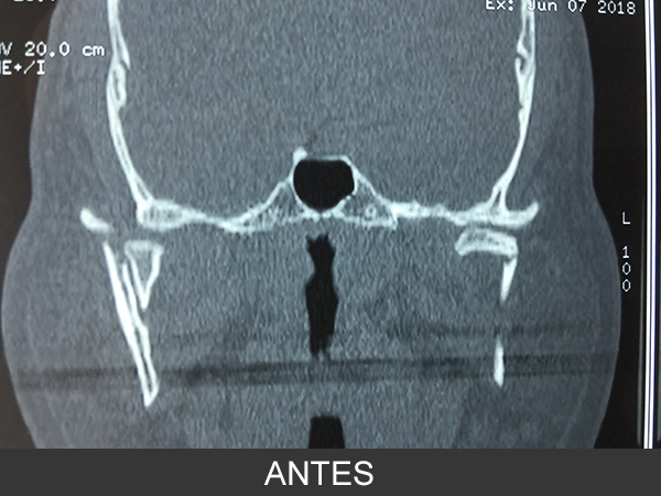 Fractura bilateral de cóndilos