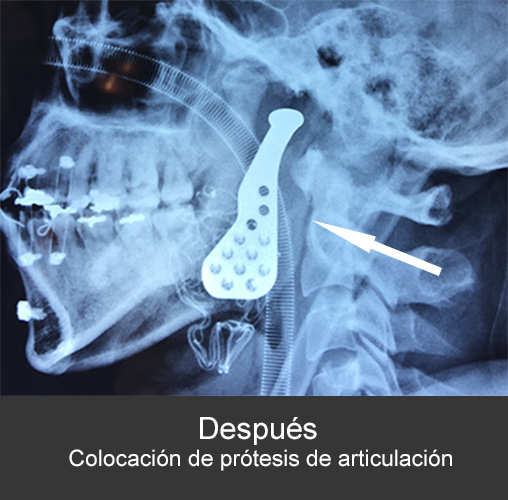 Fractura bilateral de cóndilos