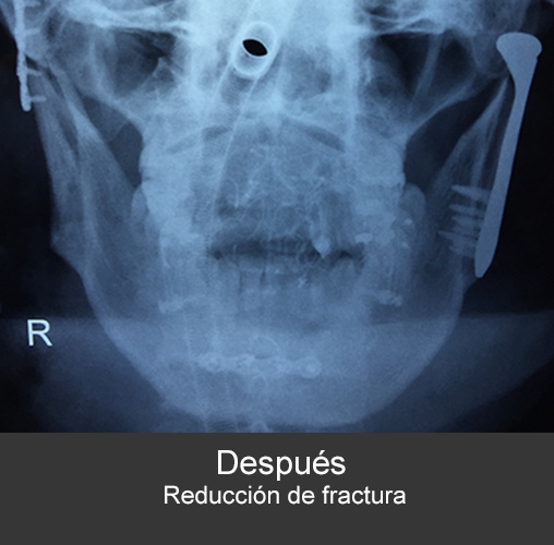Fractura bilateral de cóndilos