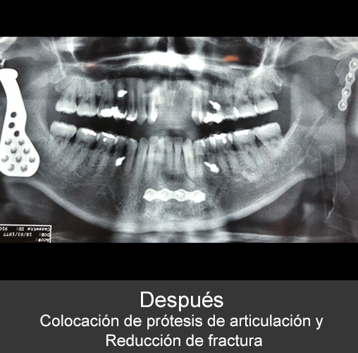 Fractura bilateral de cóndilos