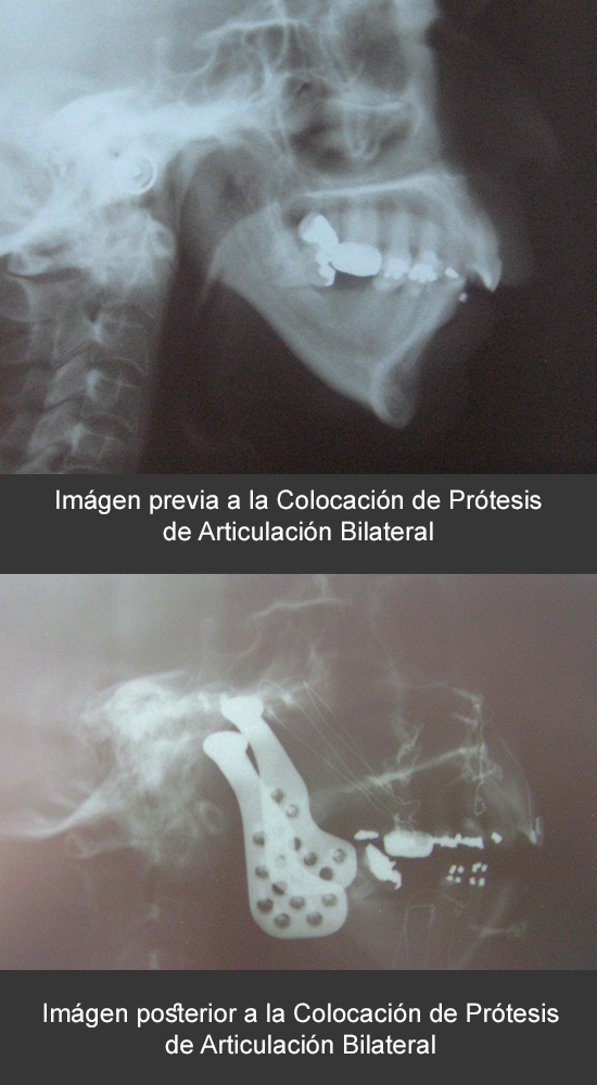 Prótesis de articulación bilateral