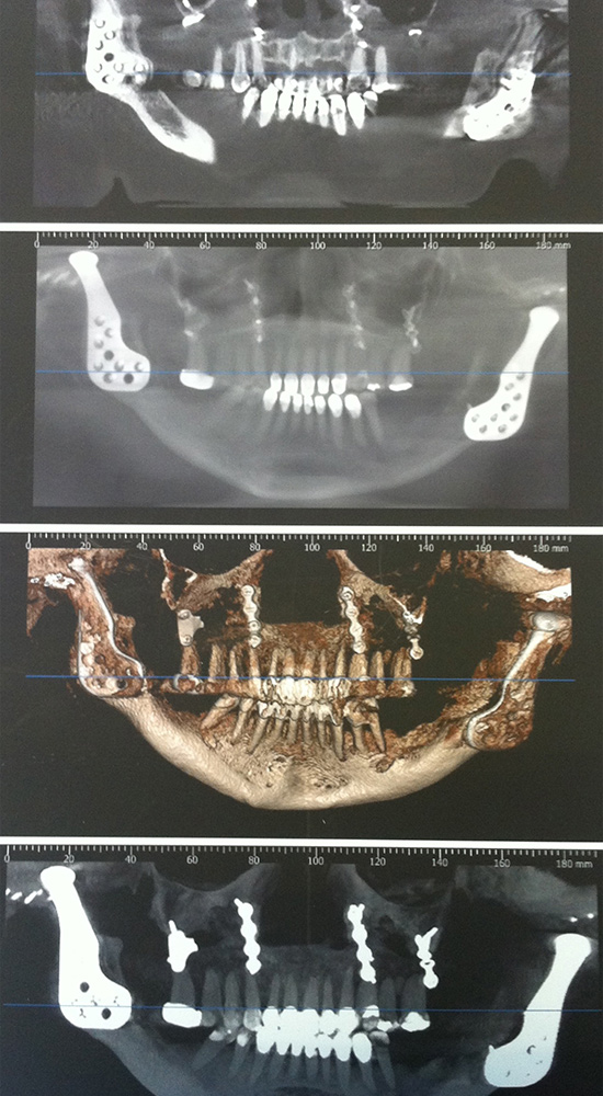 Prótesis de articulación bilateral