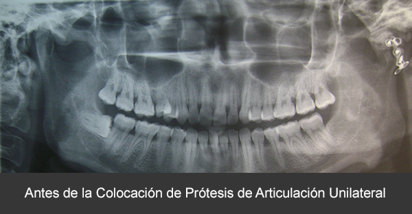 Antes