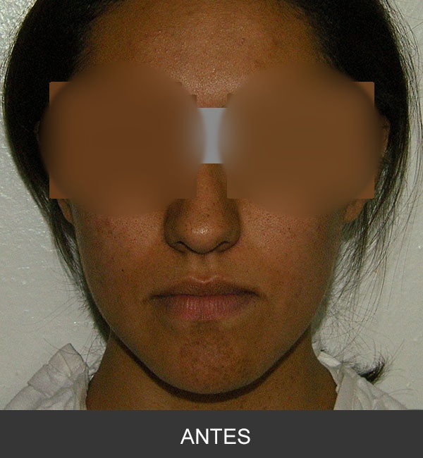 Cirugía Ortognática para corrección de Prognatismo Mandibular