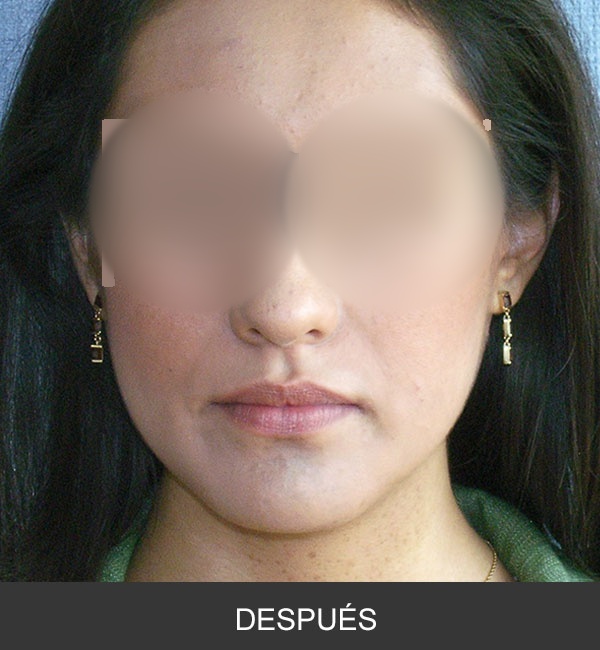 Cirugía Ortognática para corrección de Prognatismo Mandibular