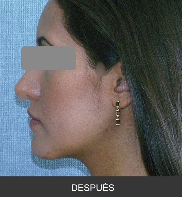 Cirugía Ortognática para corrección de Prognatismo Mandibular