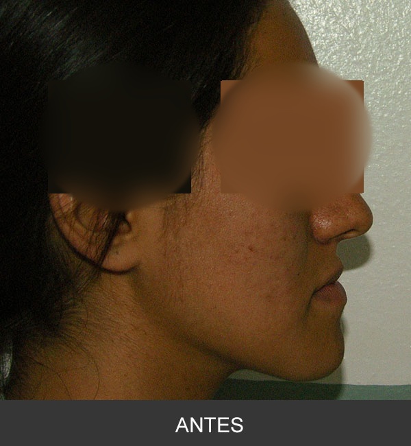 Cirugía Ortognática para corrección de Prognatismo Mandibular