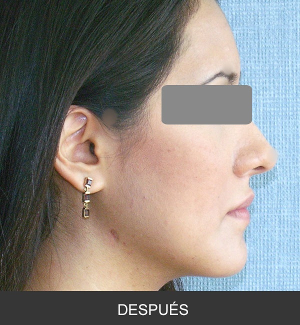Cirugía Ortognática para corrección de Prognatismo Mandibular