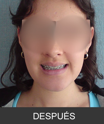 Cirugía Ortognática para corrección de Prognatismo Mandibular