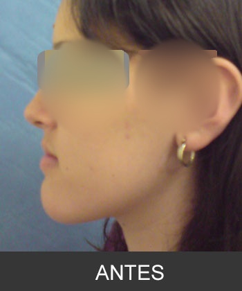 Cirugía Ortognática para corrección de Prognatismo Mandibular