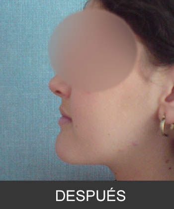 Cirugía Ortognática para corrección de Prognatismo Mandibular
