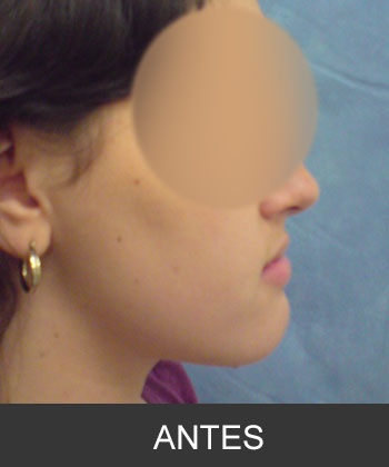 Cirugía Ortognática para corrección de Prognatismo Mandibular