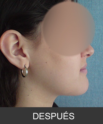Cirugía Ortognática para corrección de Prognatismo Mandibular