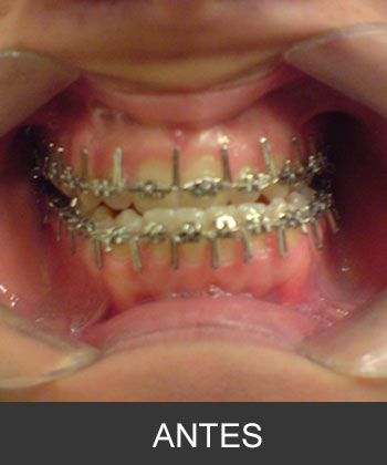 Cirugía Ortognática para corrección de Prognatismo Mandibular