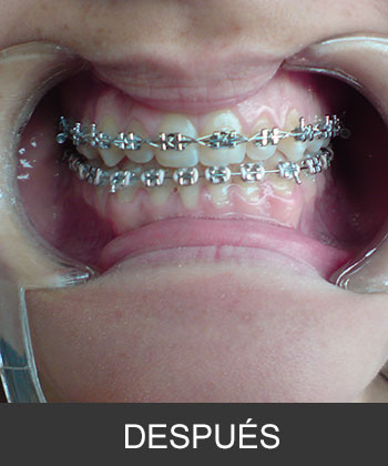 Cirugía Ortognática para corrección de Prognatismo Mandibular