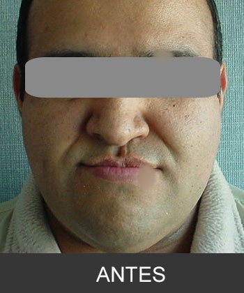 Cirugía Ortognática - Caso 1