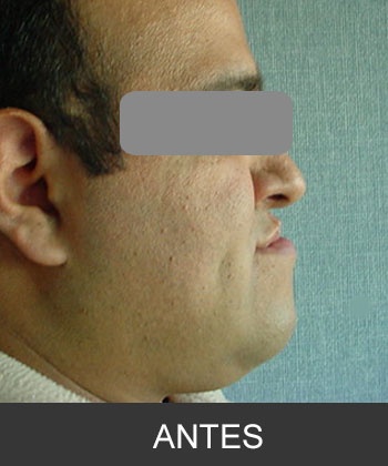 Cirugía Ortognática - Caso 1