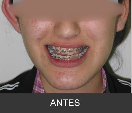 Hipoplasia maxilar - Caso 4