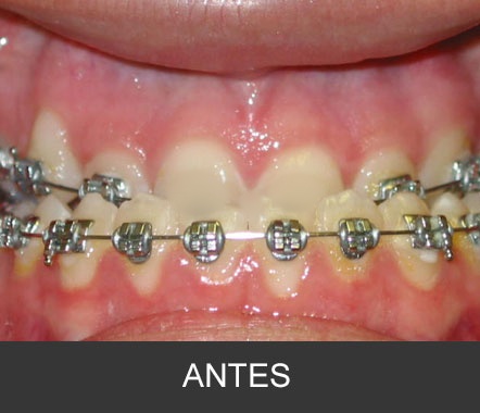Hipoplasia maxilar - Caso 4