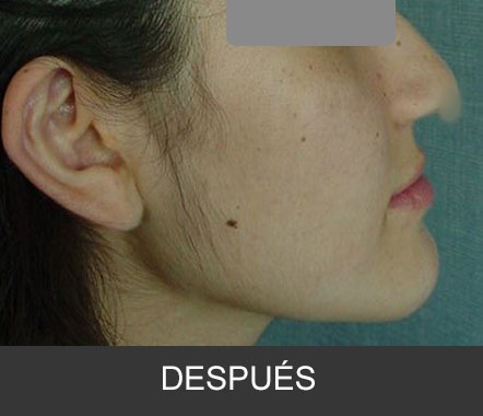Hipoplasia maxilar - Caso 4