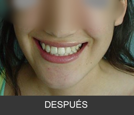 Hipoplasia maxilar - Caso 4
