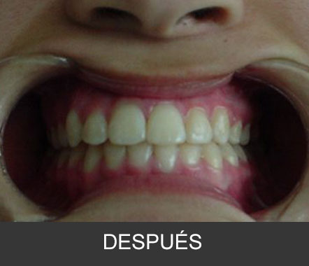 Hipoplasia maxilar - Caso 4