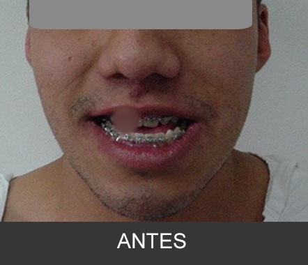 Hipoplasia maxilar - Caso 5