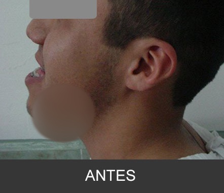 Hipoplasia maxilar - Caso 5