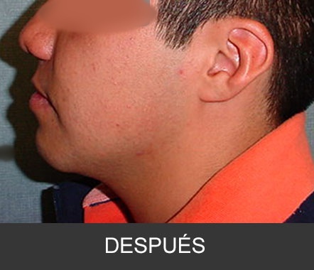 Hipoplasia maxilar - Caso 5