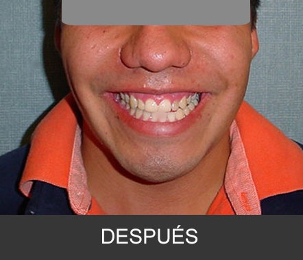 Hipoplasia maxilar - Caso 5