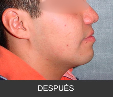 Hipoplasia maxilar - Caso 5