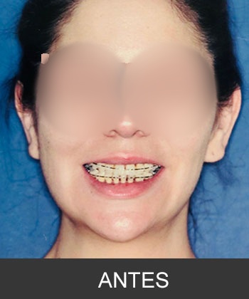 Cirugía ortognática - caso de asimetría mandibular