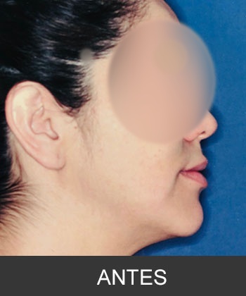 Cirugía ortognática - caso de asimetría mandibular