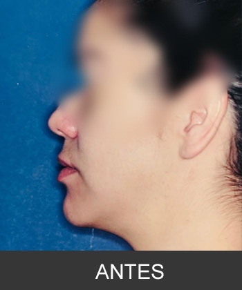 Cirugía ortognática - caso de asimetría mandibular