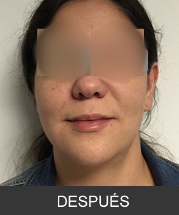 Cirugía ortognática - caso de asimetría mandibular