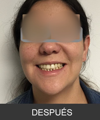 Cirugía ortognática - caso de asimetría mandibular
