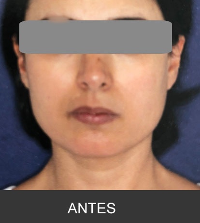 Cirugía Ortognática para corrección de mandíbula corta o deficiente